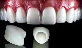 Veneer