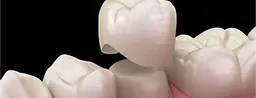 Zirconium Crown